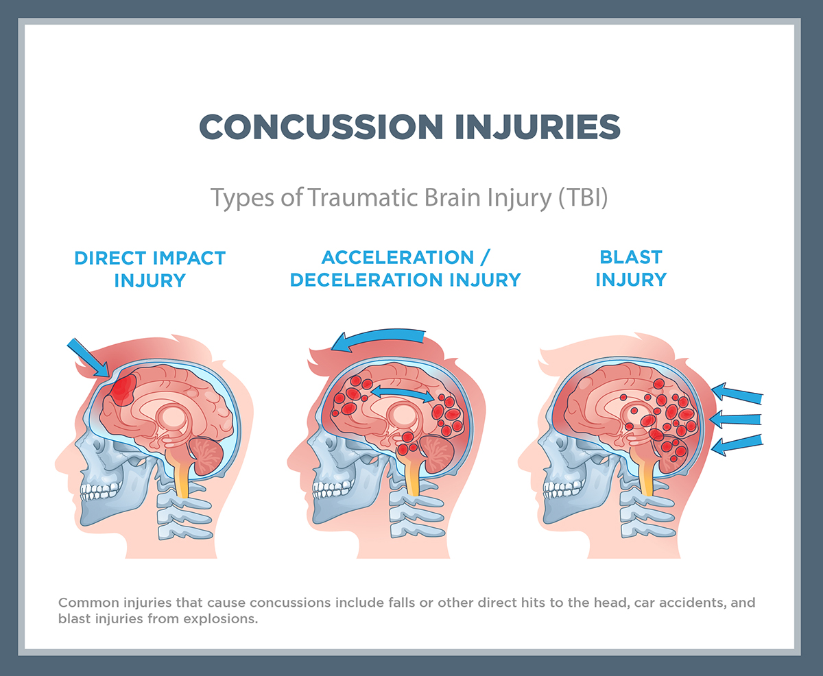 Graphic diagram showing different types of brain concussion injuries